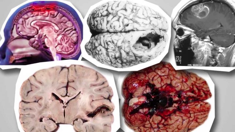 Виды нарушений мозга амебой