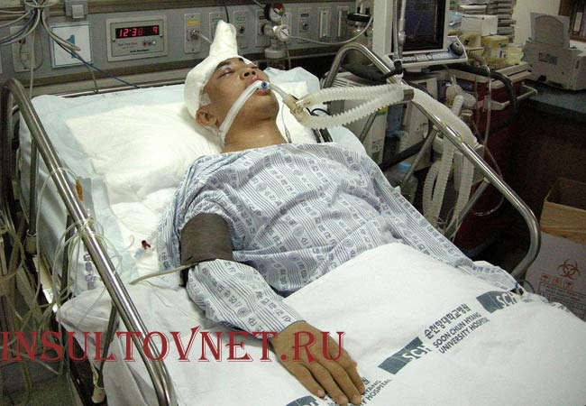 Кома после геморрагического инсульта