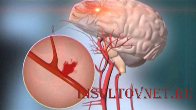 Геморрагический инсульт