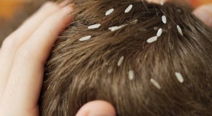 Головные вши