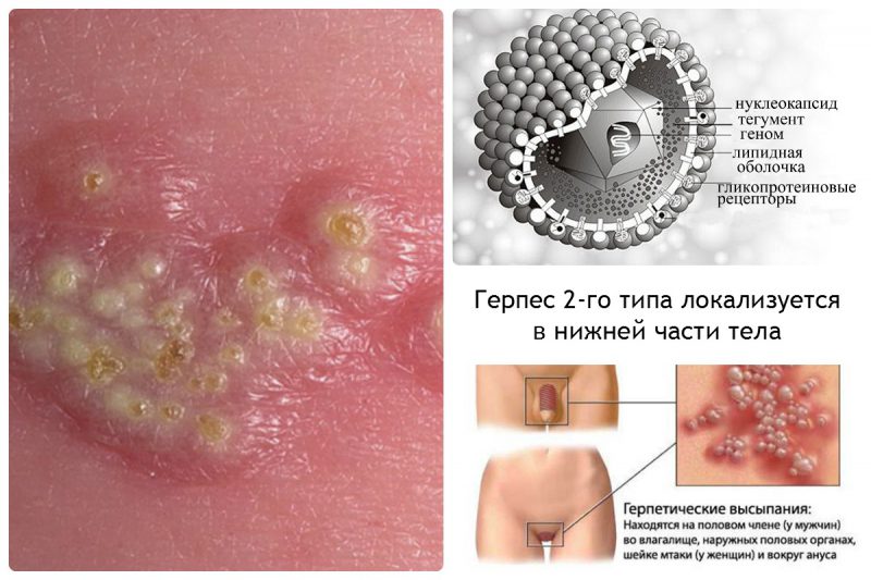 симптомы и причины герпеса