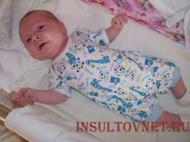 Симптоматическая парциальная эпилепсия