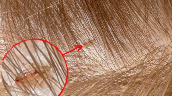 формы Педикулеза