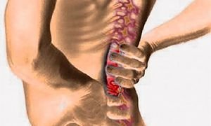 Медикаментозное лечение поясничного радикулита и его симптомы