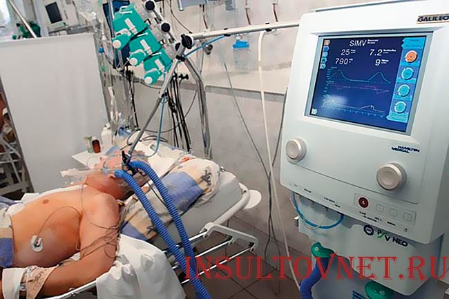 Кома после инсульта