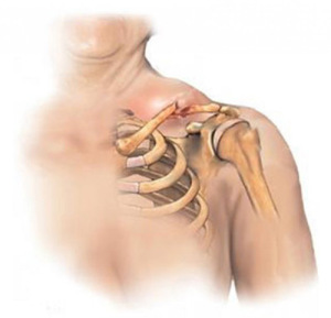 Перелом ключицы Перелом ключицы может принести много неудобств