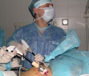 лапароскопия