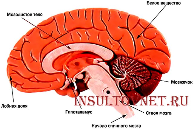 Инсульт мозжечка