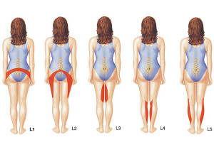Локализация болей при межпозвоночной грыже Симптомы грыжи межпозвоночного диска