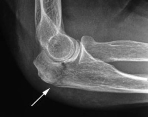 Рентген локтя Рентгенологическое исследование