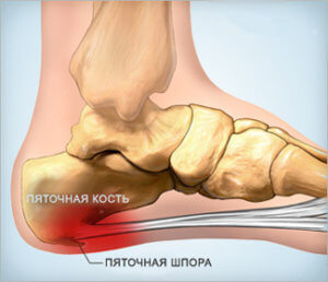 Как выглядит пяточная шпора у детей