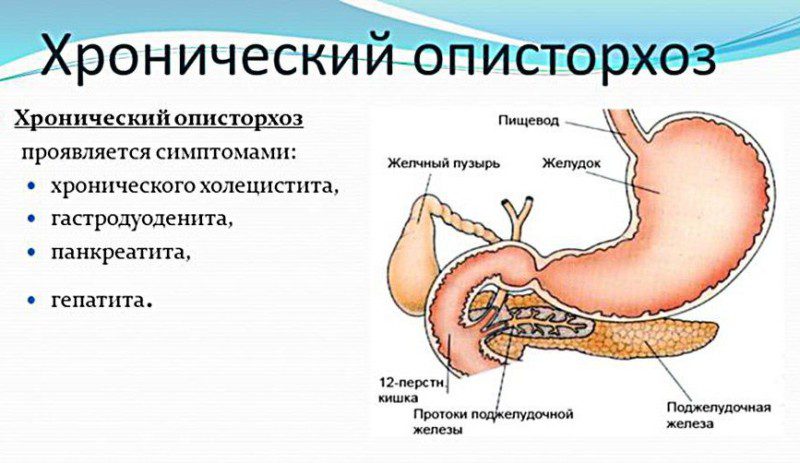 хронический описторхоз