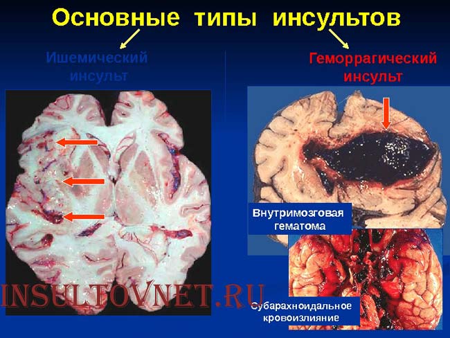 ишемический и геморрагический инсульт