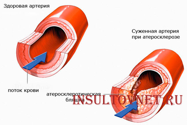 Атеросклероз сосудов