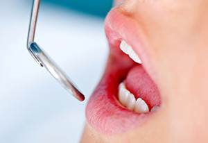 Осмотр зубов Чаще всего поражаются зубы нижней челюсти