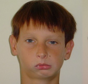 Челюстная деформация Челюстная деформация, одно из последствий заболевания